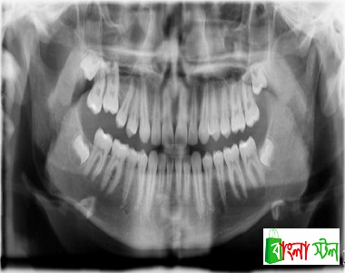 X Ray for Individual Teeth