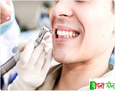 Tooth Polishing Price in BD | Tooth Polishing